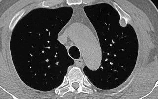 Osteochondroma